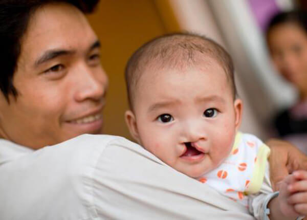 Hội chứng DiGeorge Hội chứng DiGeorge
