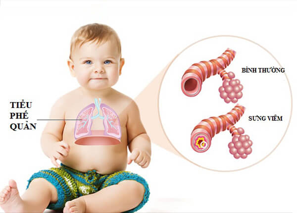Trẻ em mắc bệnh viêm phế quản Trẻ em mắc bệnh viêm phế quản
