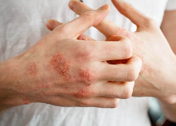Bệnh viêm da mủ hoại thư Bệnh viêm da mủ hoại thư