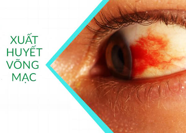 Xuất huyết võng mạc Xuất huyết võng mạc