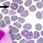 Bác sĩ Trường Dược Sài Gòn và những chia sẻ về bệnh Babesia