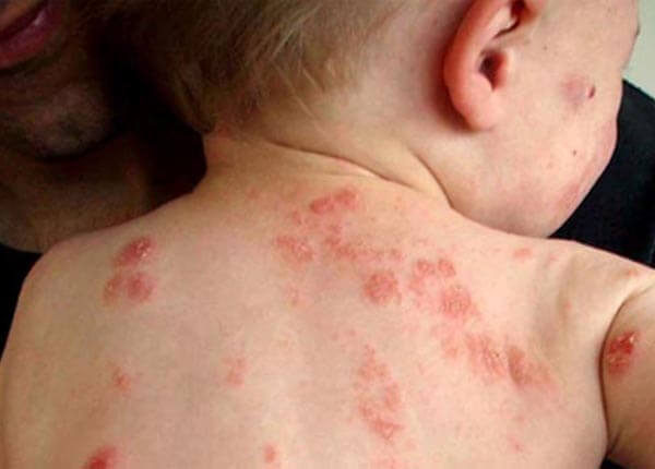 Bệnh viêm da dị ứng ở trẻ em Bệnh viêm da dị ứng ở trẻ em