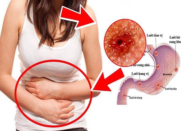 Bệnh viêm loét dạ dày Bệnh viêm loét dạ dày