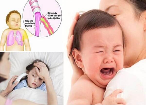 Chăm sóc trẻ bị viêm phế quản Chăm sóc trẻ bị viêm phế quản