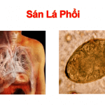 Bác sĩ Trường Dược Sài Gòn chia sẻ thông tin bệnh sán lá phổi