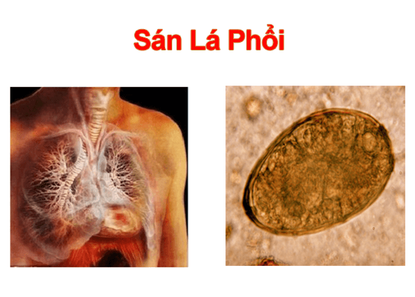 Bệnh sán lá phổi Bệnh sán lá phổi