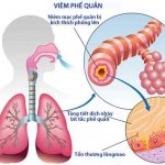 Chia sẻ về bệnh viêm phế quản cấp tính từ Bác sĩ Trường Dược Sài Gòn