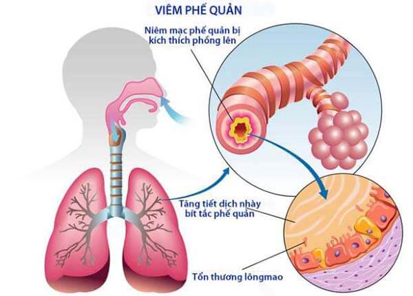 Bệnh viêm phế quản cấp tính Bệnh viêm phế quản cấp tính