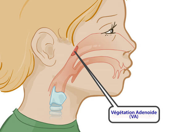 Viêm VA ở trẻ em