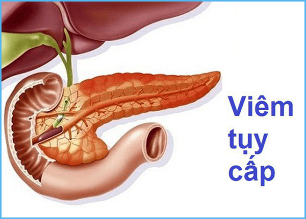Bệnh viêm tụy cấp Bệnh viêm tụy cấp