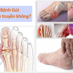 Người mắc bệnh gút có khả năng lây truyền bệnh không?