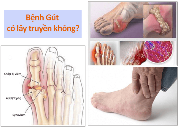 Bệnh gút có khả năng lây truyền bệnh không? Bệnh gút có khả năng lây truyền bệnh không?