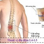 Những lưu ý về bệnh gai cột sống L4 L5 từ Bác sĩ Trường Dược Sài Gòn