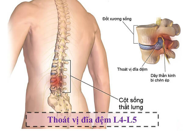 Những lưu ý về bệnh gai cột sống L4 L5 từ Bác sĩ Trường Dược Sài Gòn