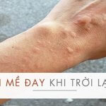 Lưu ý về tình trạng nổi mề đay do lạnh từ B.s Trường Dược Sài Gòn