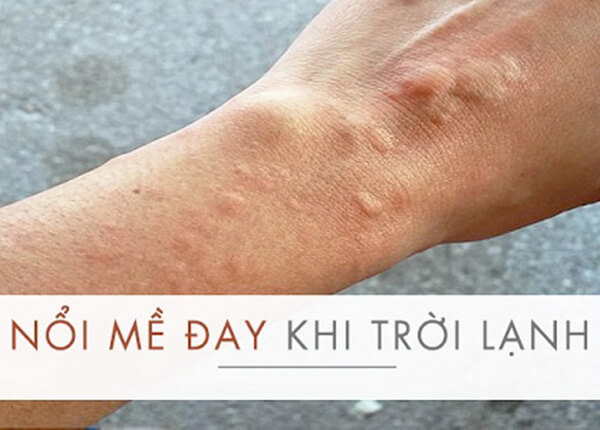 Nổi mề đay do lạnh Nổi mề đay do lạnh
