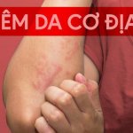 Chia sẻ về bệnh viêm da cơ địa từ Bác sĩ Trường Dược Sài Gòn