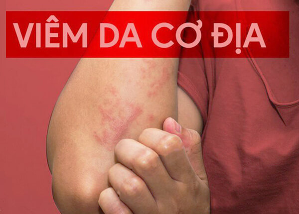 Bệnh viêm da cơ địa Bệnh viêm da cơ địa