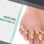 Bác sĩ Trường Cao đẳng Dược Sài Gòn chia sẻ về bệnh nấm kẽ
