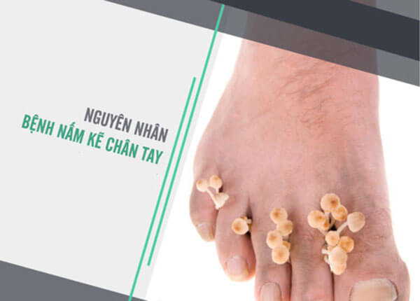 Bệnh nấm kẽ Bệnh nấm kẽ