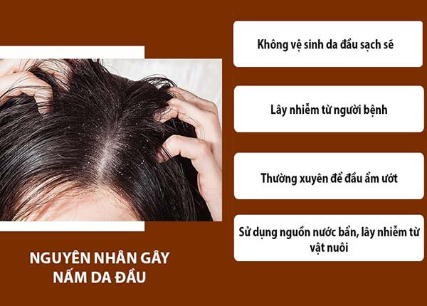 Tìm hiểu nguyễn nhân dẫn tới nấm da đầu từ B.s Trường Dược Sài Gòn