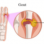 Bác sĩ Trường Cao đẳng Dược Sài Gòn chia sẻ về bệnh Gout