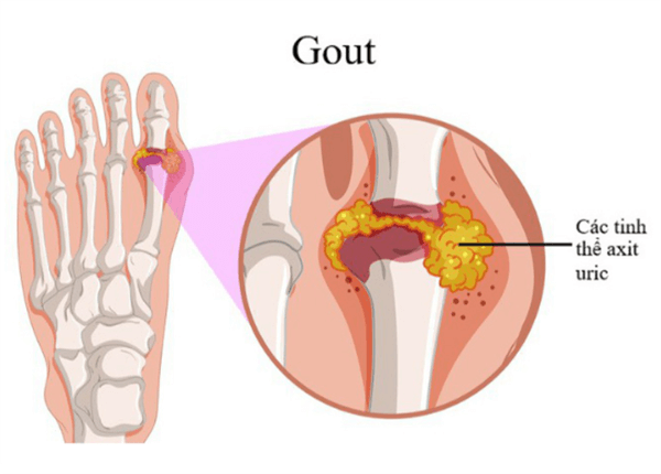 bệnh Gout bệnh Gout