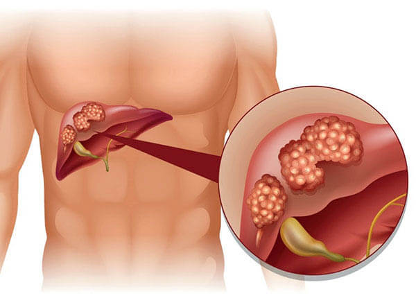 bệnh viêm gan tự miễn bệnh viêm gan tự miễn
