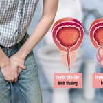 Bác sĩ Trường Dược Sài Gòn chia sẻ thông tin bệnh viêm tuyến tiền liệt
