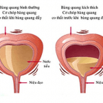 B.s Trường Dược Sài Gòn chia sẻ về bệnh bàng quang tăng hoạt