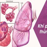 Người mắc bệnh khí phế thũng cần phải lưu ý gì?