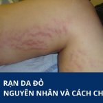 Cần lưu ý gì khi gặp hiện tượng nổi vết rạn da màu đỏ?