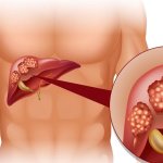 Hiểu biết về bệnh viêm gan – Chẩn đoán và điều trị