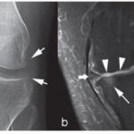 Viêm khớp trông như thế nào trên MRI?