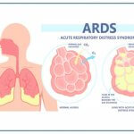 Tổng quan về hội chứng suy hô hấp cấp tiến triển (ARDS)