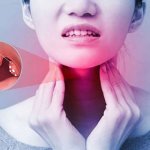 Cách điều trị và phòng bệnh viêm họng mạn tính