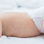Bệnh rôm sảy và những phương pháp điều trị bệnh hiệu quả