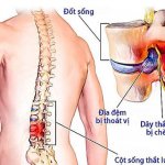 Có thể điều trị dứt điểm thoát vị đĩa đệm cột sống thắt lưng không?